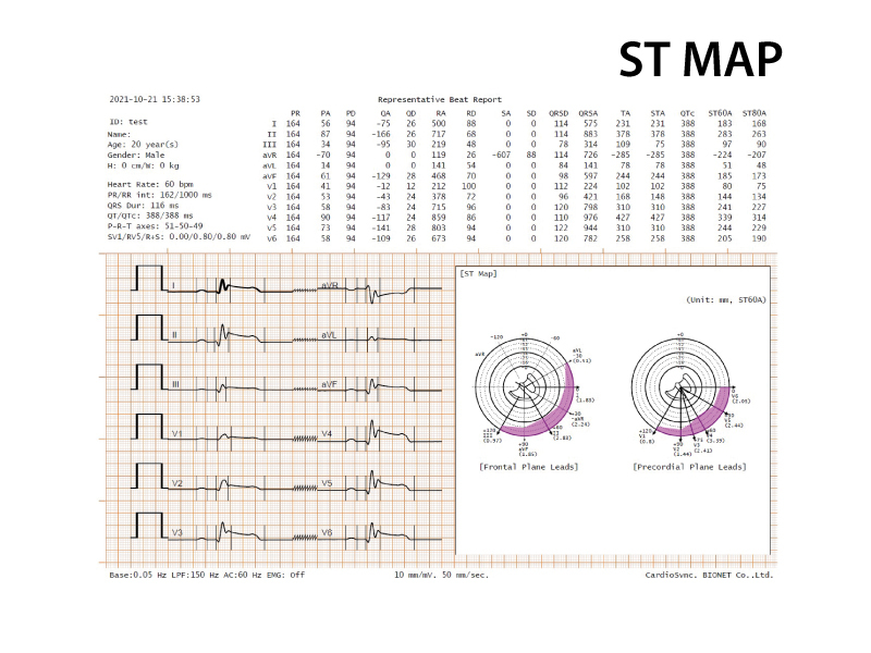 CardioP1 special report stmap